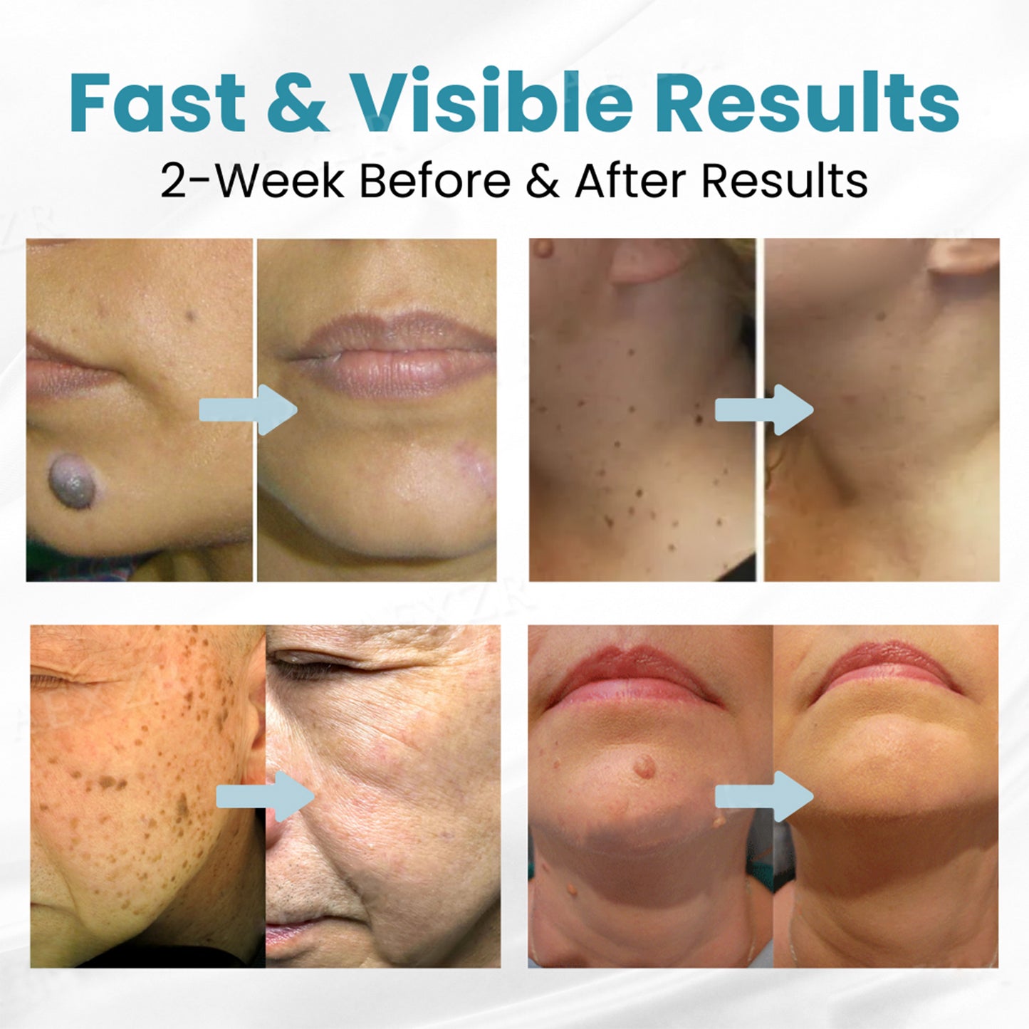 Non-Invasive Mole and Wart Removal (BUY 1 GET 1 FREE)