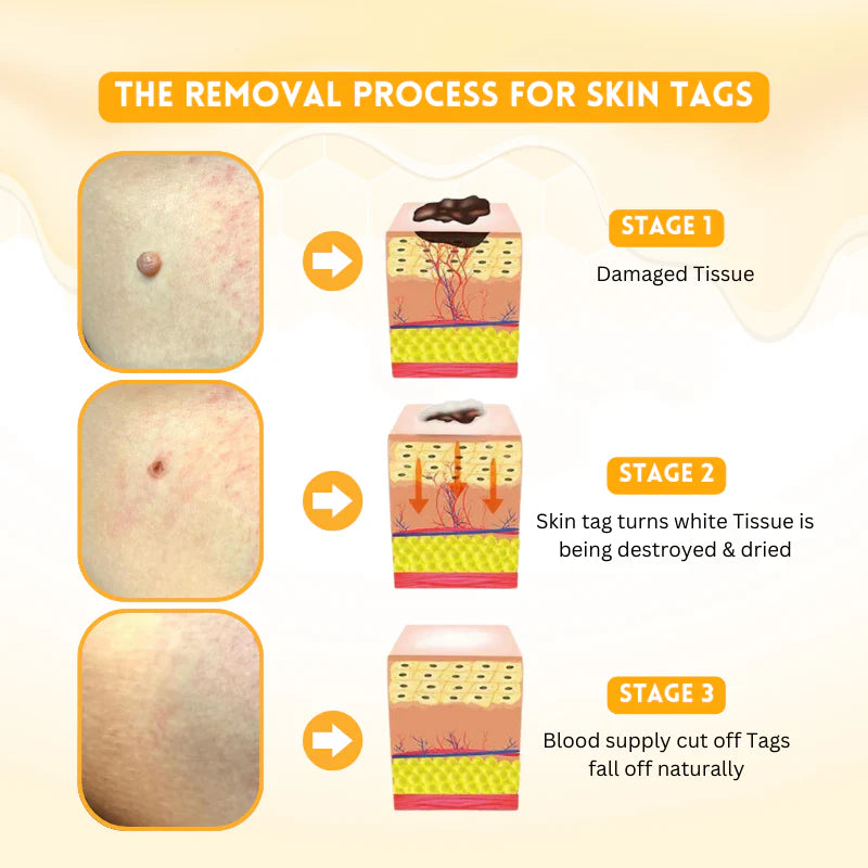 Biancat™ DermRenew Bee Venom Multi-Action Ward Remover Cream