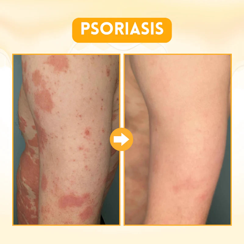 Biancat™ DermRenew Bee Venom Multi-Action Ward Remover Cream