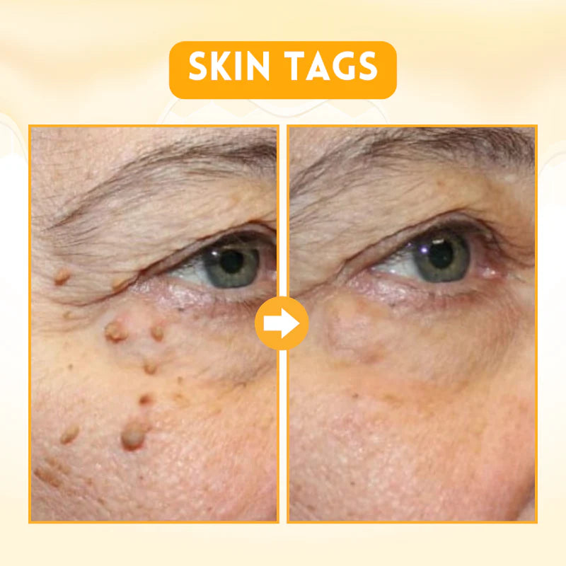 Biancat™ DermRenew Bee Venom Multi-Action Ward Remover Cream