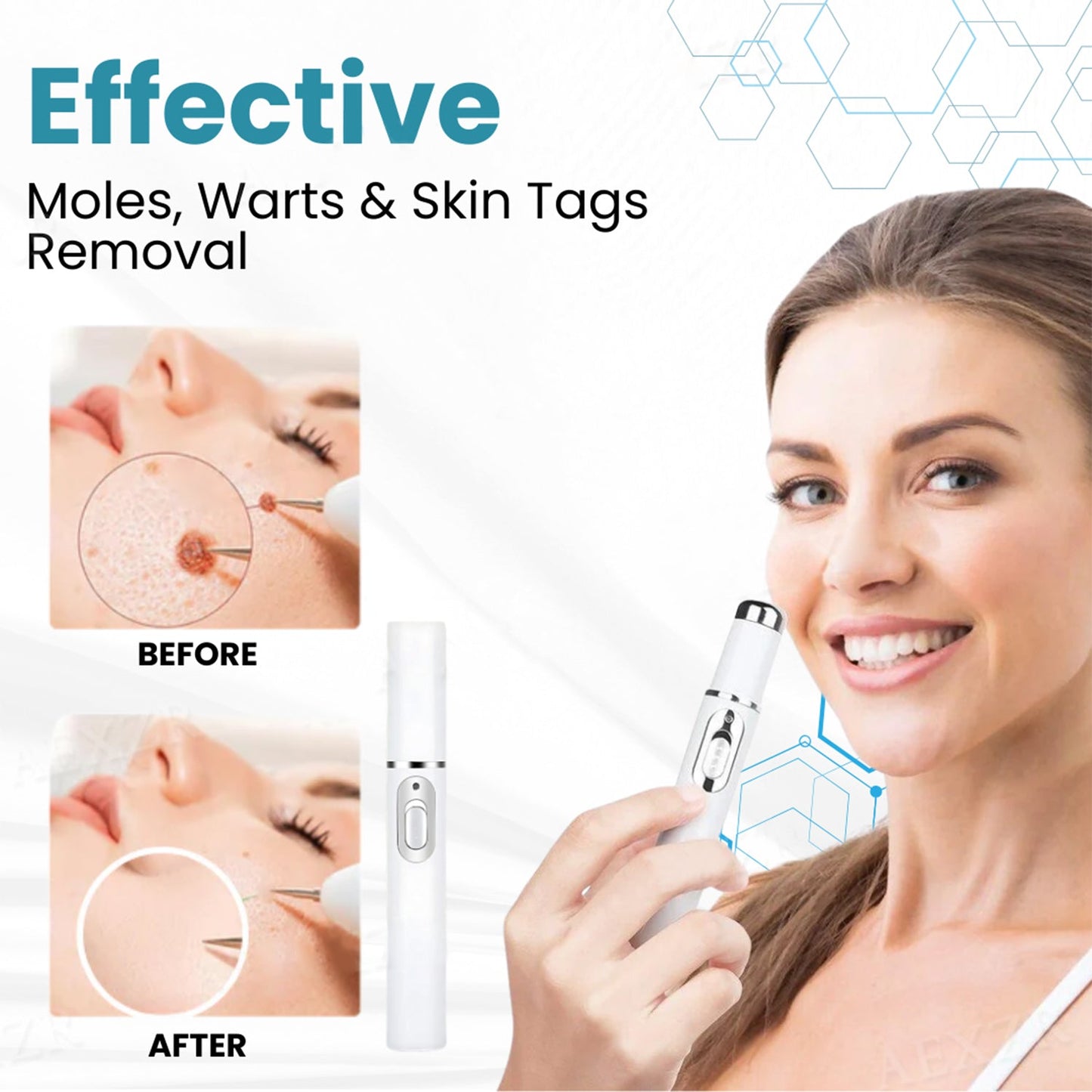 Non-Invasive Mole and Wart Removal (BUY 1 GET 1 FREE)